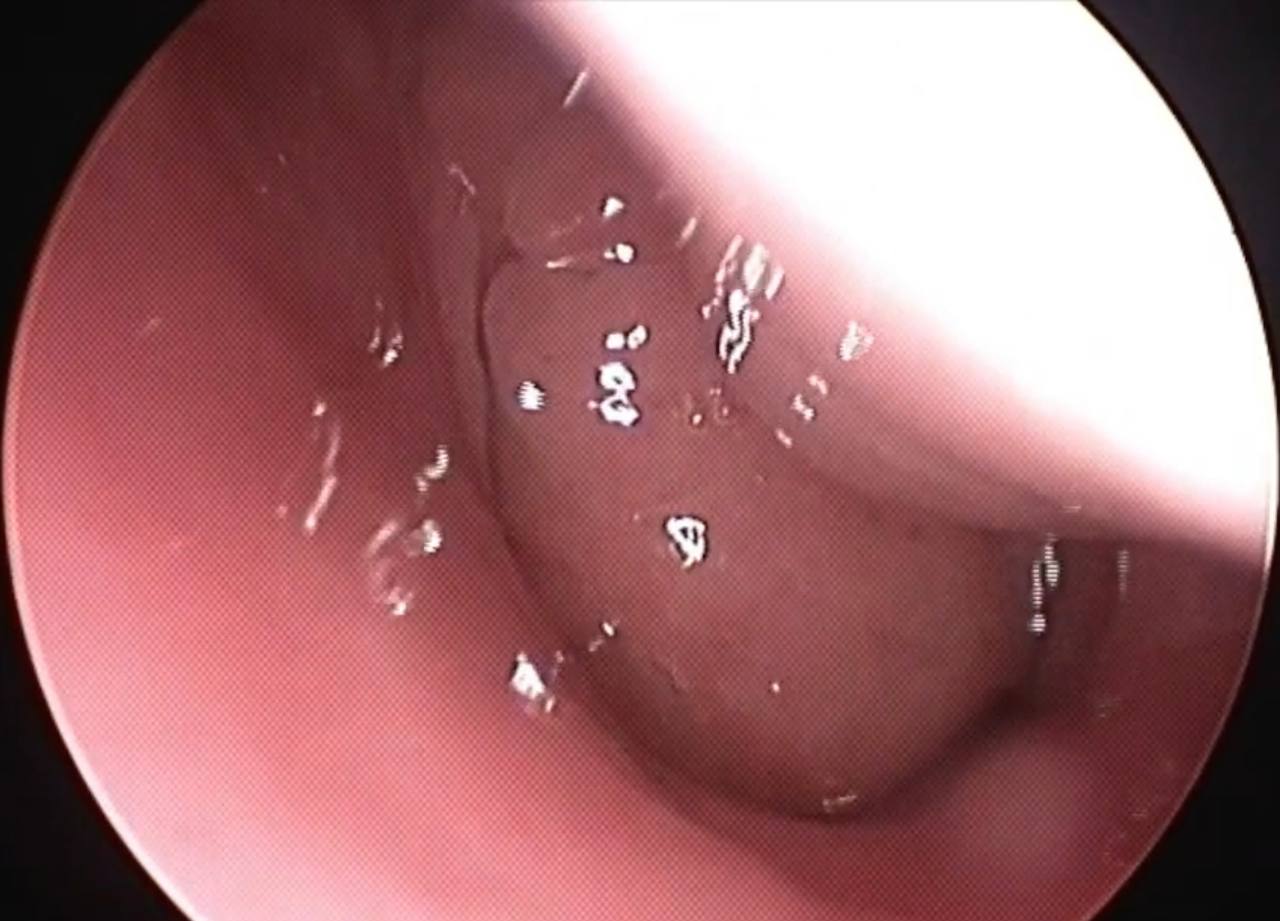 adenoid