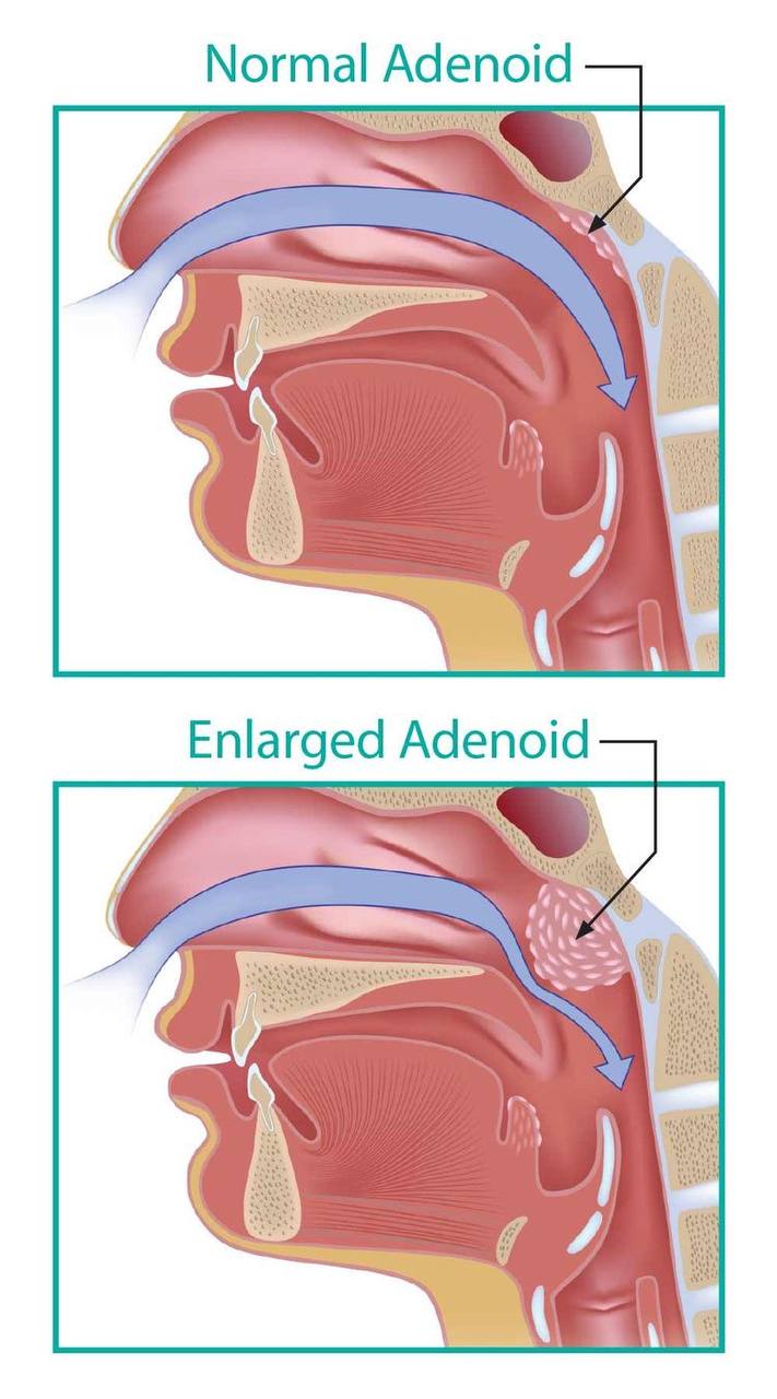 adenoid