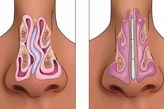 adenoid