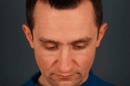фото до ринопластики