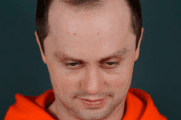 фото після ринопластики