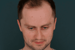 фото до ринопластики